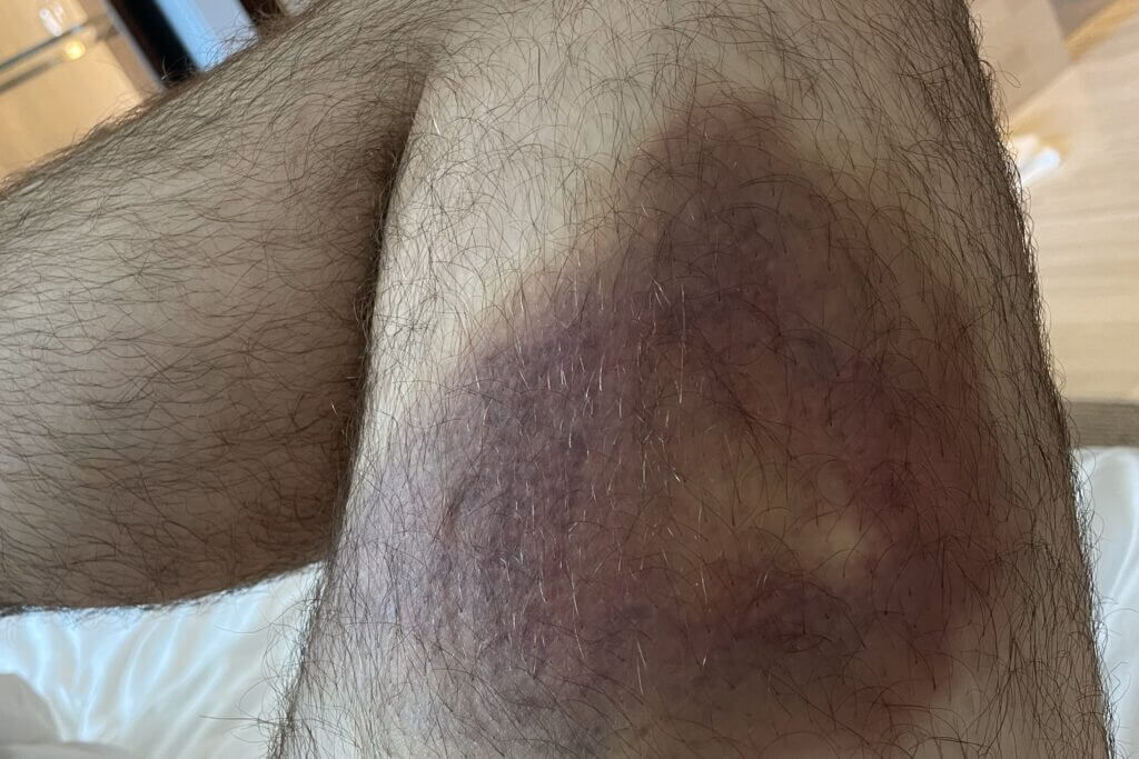 Uncovering the Unexpected Signs of Cancer: From Athletic Bruises to Routine Checkups